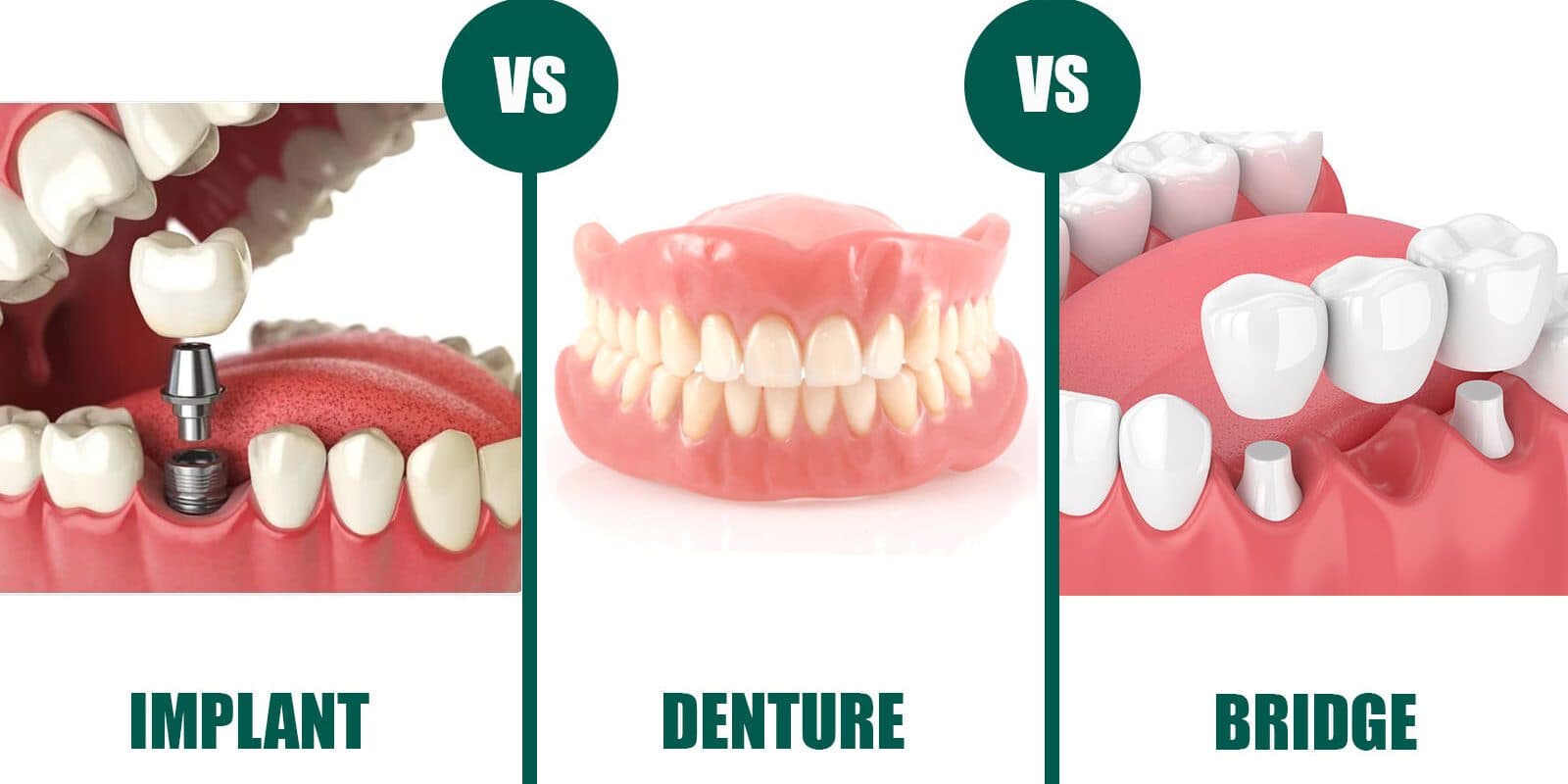 Dental Implants vs. Dentures vs. Bridges — Which One Is Right for You?
