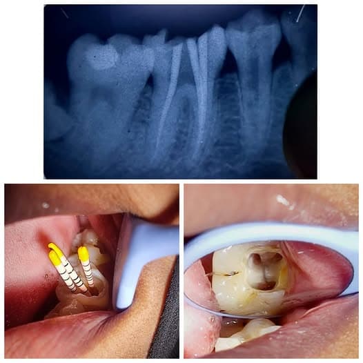 5 Signs You Need a Root Canal (Not Just a Filling)